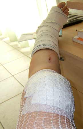 Les degats sur la jambe